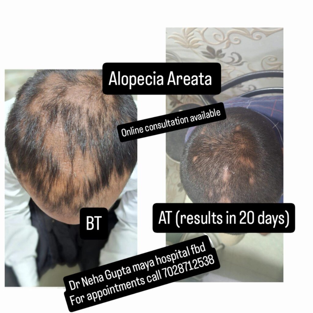 Alopecia areata before and after in 20 days
