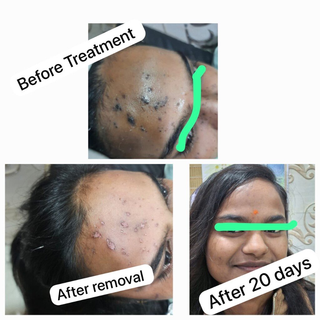 Freckle removal before, after removal, and after 20 days