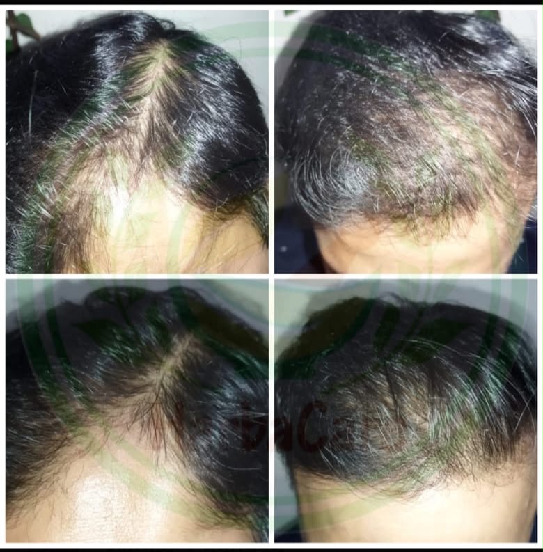 Hair growth before and after treatment results