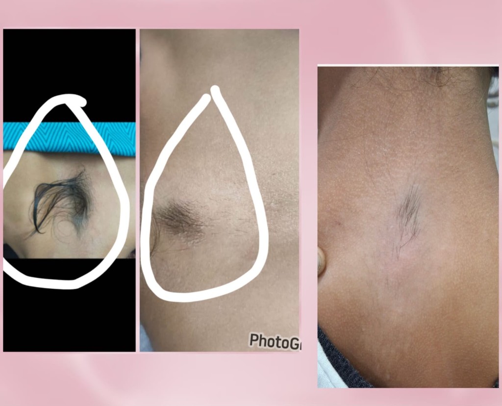 Laser hair reduction treatment progress