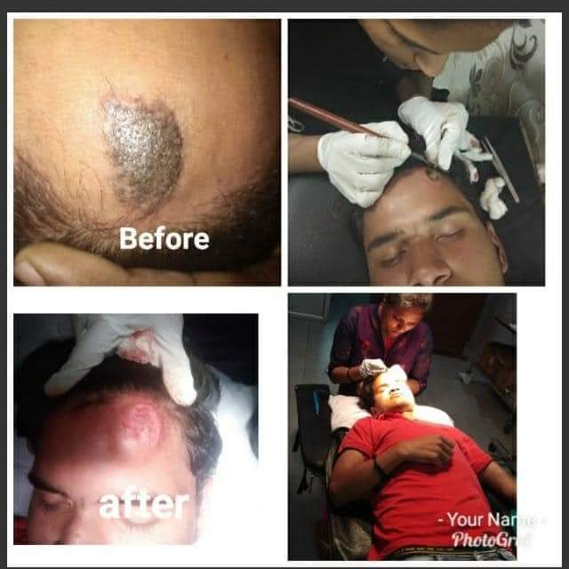 Lesion removal procedure before and after with doctor and patient