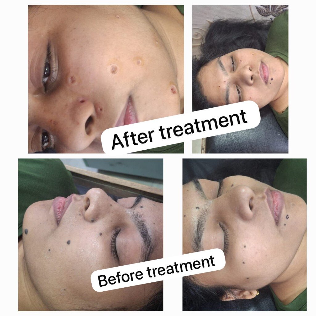 Mole removal before and after treatment