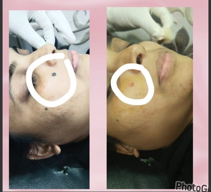 Skin treatment care tips