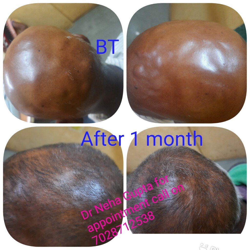 Scalp before treatment and after one month